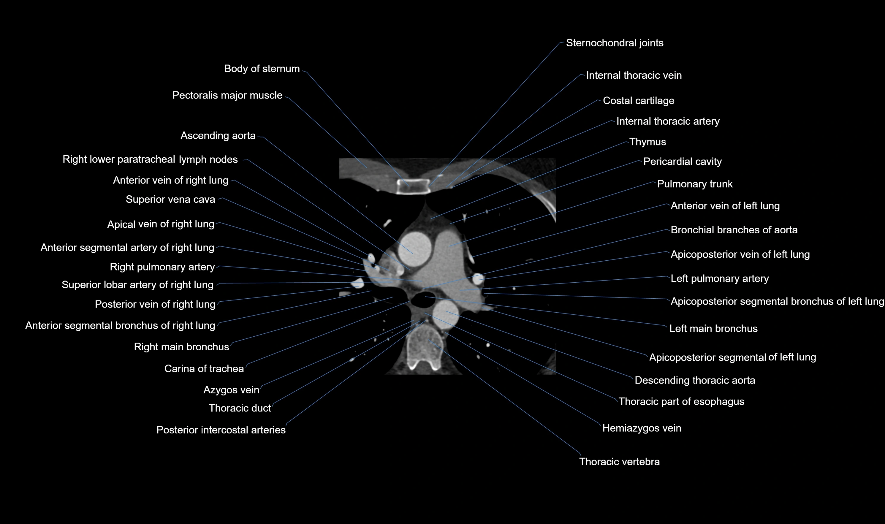 CT heart (coronary angiogram) axial view cross sectional anatomy labelled radiology image-00008.webp